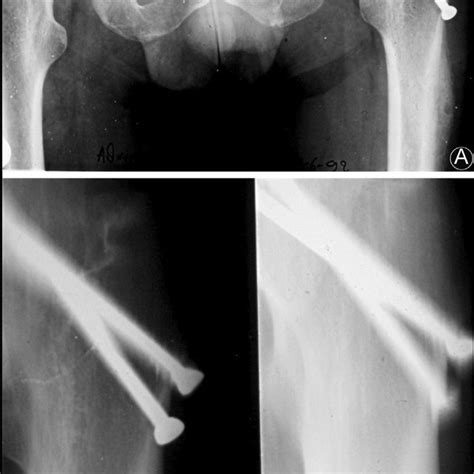 Anteroposterior Radiograph Of The Left Hip Showing Fracture Healing 6