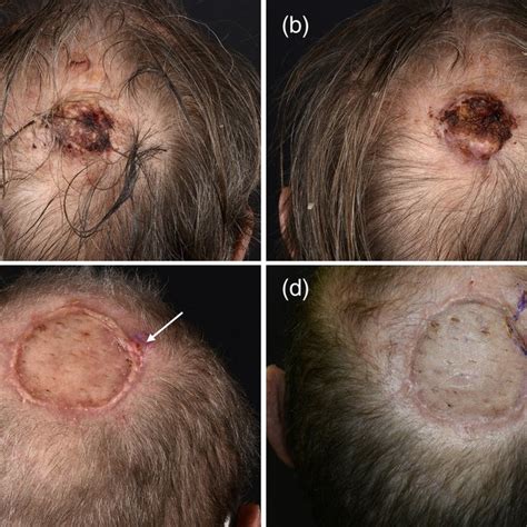 A B Primary Cutaneous Squamous Cell Carcinoma Cscc Located On The