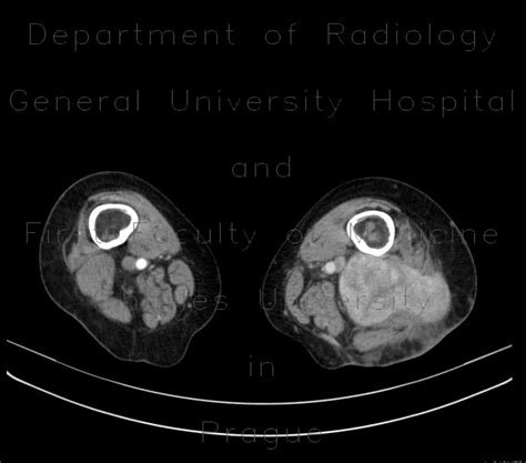 Radiology Case Liposarcoma Of Thigh