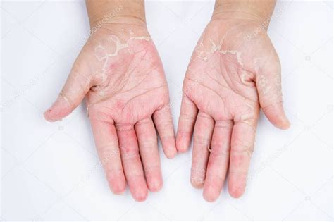 Dry Hands Peel Contact Dermatitis Fungal Infections Skin Inf