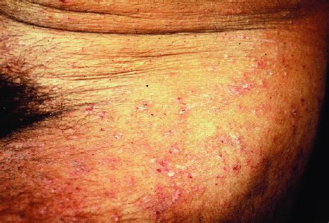 Scabies Rash Seen Around The Waist And Thighs A Common Polymorphic Download Scientific Diagram