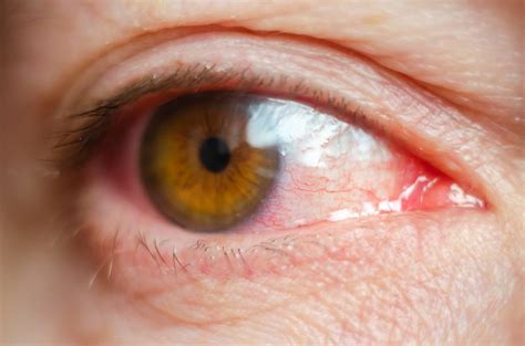 Uveitis is classified anatomically as. Uveitis