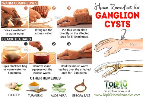 Home Remedies For Ganglion Cysts Oils Top 10 Home Remedies