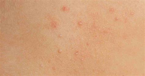 Molluscum Contagiosum Pictures And Symptoms