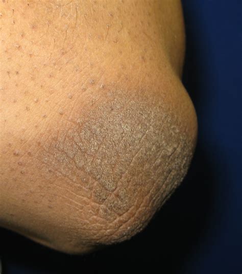 Acanthosis Nigricans The Clinical Advisor