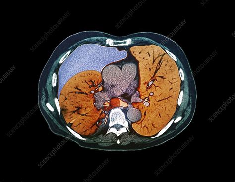 Risk factors for a pneumothorax. Pneumothorax, CT scan - Stock Image - C013/2179 - Science ...