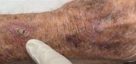 Squamous Cell Carcinoma Squamous Cell Skin Cancer St Louis