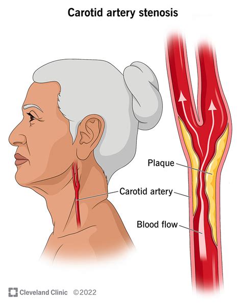 Carotid Artery Stenosis Causes Symptoms And Treatment