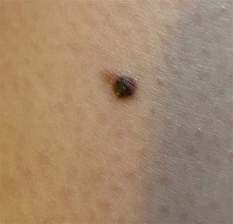 Woman Shares Picture Of Freckle That Turned Out To Be Skin Cancer