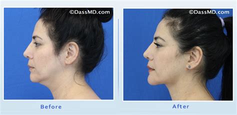 11 Neck Liposuction Scars Thomsonjemba