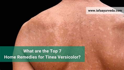 What Are The Top 7 Home Remedies For Tinea Versicolor