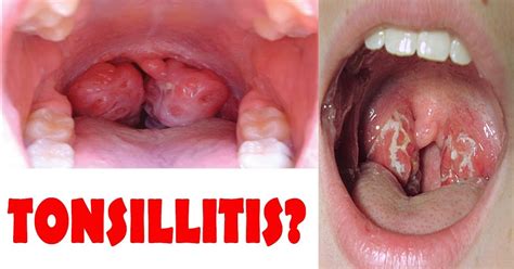 How To Get Rid Of Tonsillitis Without Antibiotics Learning Petals