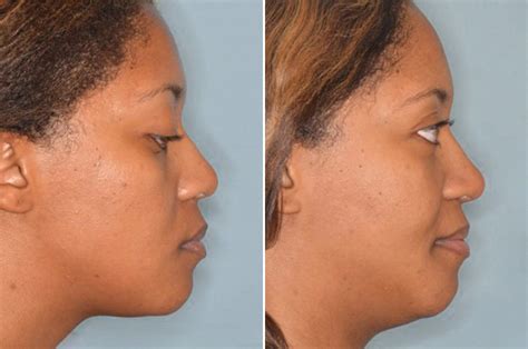 Ethnic Rhinoplasty Photos Miami Fl Patient 1004