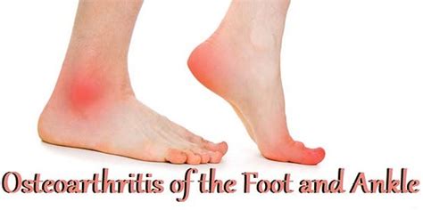 Osteoarthritis Of The Ankle What Is Osteoarthritis Osteoarthritis