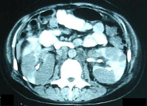 Ct Scan Of The Abdomen Showing Enlarged Retroperitoneal Lymph Nodes And