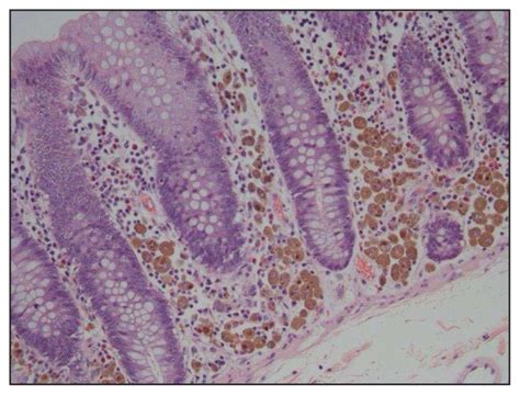 Melanosis Coli A Case Of Mistaken Identity—a Case Report The