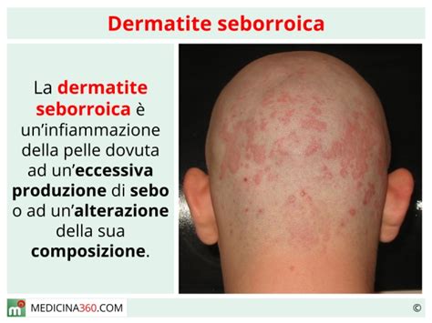 Dermatite Seborroica Cause Sintomi E Rimedi