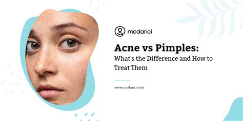 Acne Vs Pimples Whats The Difference And How To Treat Them Modanci