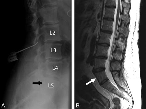 Mri Spine Lumbar And Sacral Anatomy - mri scan machine
