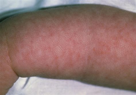Baby Girls Arm Showing Rash From Viral Meningitis Photograph By Dr P