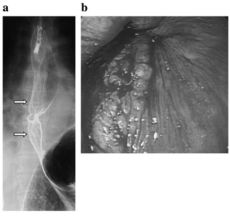 A Case Of Esophageal Cancer With Multiple Lymph Node Metastases Which