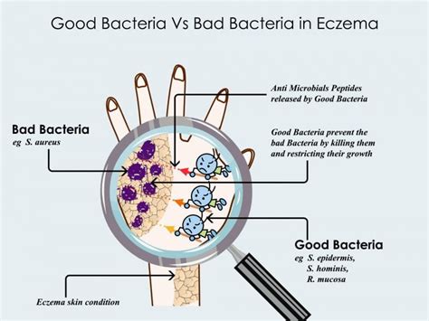 What Is Microbiome What Is Human Microbiome Role In Eczema Eczema