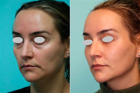 Blepharoplasty Fat Transfer Tear Trough Under Eye Injections Photos Chevy Chase Md