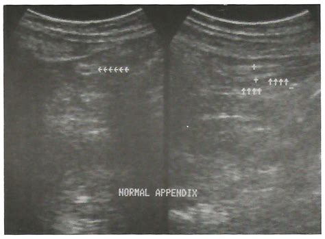 Figure 1 From Sonographic Appearance Of Normal Appendix In Children