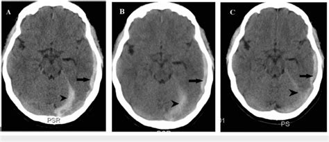 Non Contrast Axial Computed Tomography Brain A On Readmission Showing