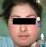 Moon Face Treatment Pictures