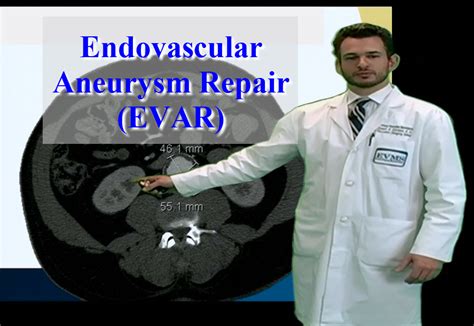 Subspecialties Vascular Surgery Endovascular Aneurysm Repair Evar