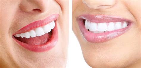 pros and cons of porcelain veneers cosmetic dentist smile angels of beverly hills bruce vafa