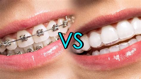 Invisalign Before After Results Schaumburg Dentistry