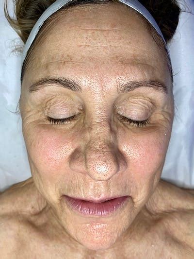 Diamondglow Facial Before And After Photos Beauty Within