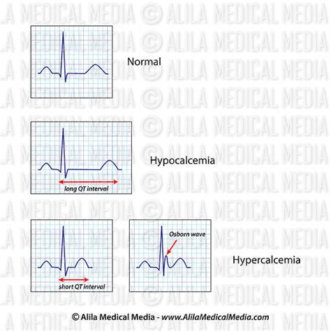 Alila Medical Media ECG de hipercalcemia e hipocalcemia Ilustración