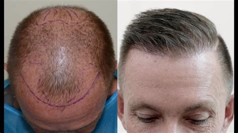 Hair Transplant Methods A Brief History CRAZY SPEED TECH