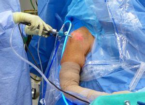 Rotator Cuff Repair Surgery | Shoulder & Sports Medicine ...