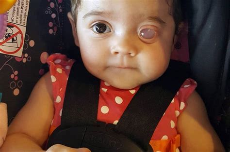 Adorable Infant Born Without An Eye Faces Challenging Treatment To
