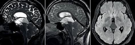 Geburtstag sichtbar geschwächt in der öffentlichkeit gezeigt, er hatte schwierigkeiten beim gehen und sprechen. Klinik und Poliklinik fuer Neurochirurgie: Pineal cysts