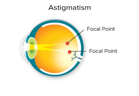 Astigmatism Iris Ophthalmology Clinic