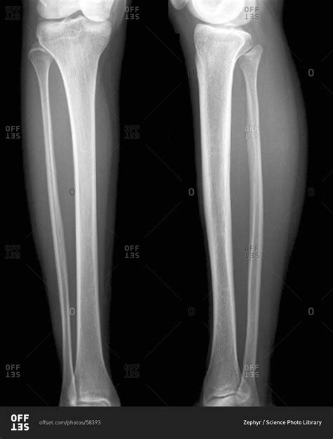 Normal Lower Legs Frontal X Ray Stock Photo Offset