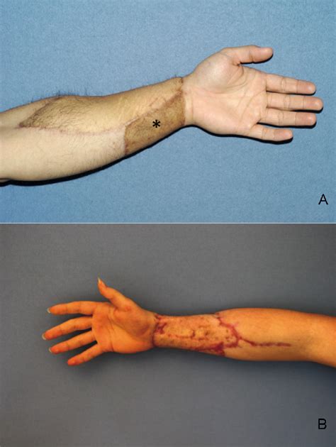 Comparative Study Of The Free Microvascular Groin Flap Optimizing The