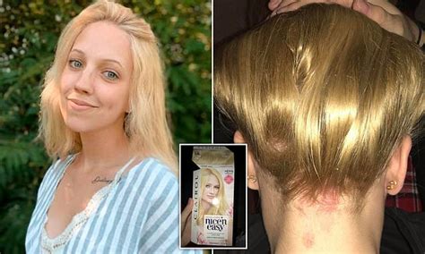 Teenager Who Used Hair Dye To Turn Her Roots Blonde Is Left With Bald
