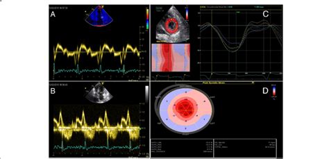 Mitral Valve Inflow Pulsed Wave Doppler A And Tissue Doppler Imaging