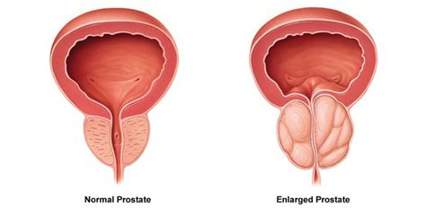 Transurethral Resection Of Prostate Turp Chin Chong Min Urology And Robotic Surgery Centre