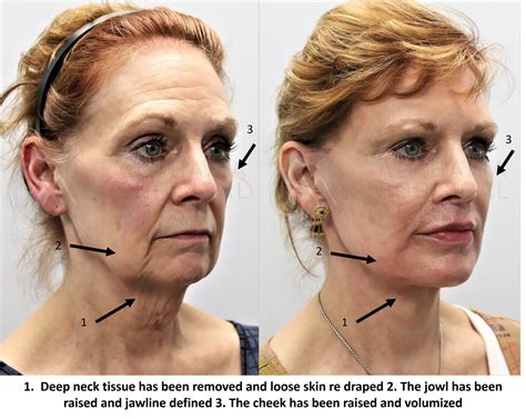 Facelift Montgomery Lower Face And Neck Lift Alabama Surgical Arts