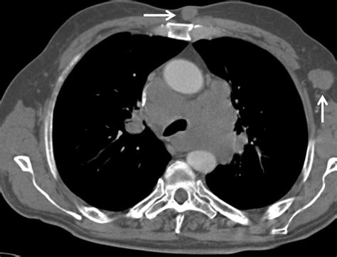 Ct Thorax Showing Extensive Mediastinal Lymphadenopathy With Encasement