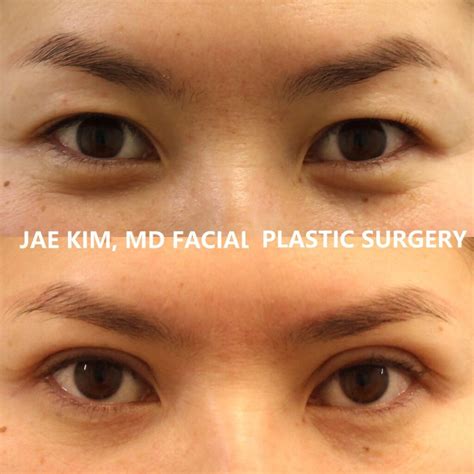 What Should I Expect During My Recovery After Asian Eyelid Surgery