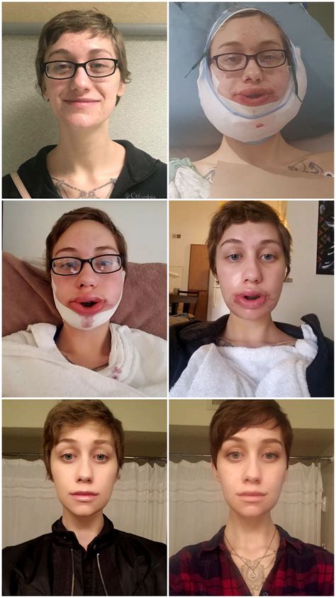 Jaw Surgery Before And After