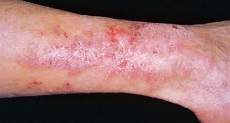 Celiac Rash Pictures Medical Pictures And Images 2022 Updated